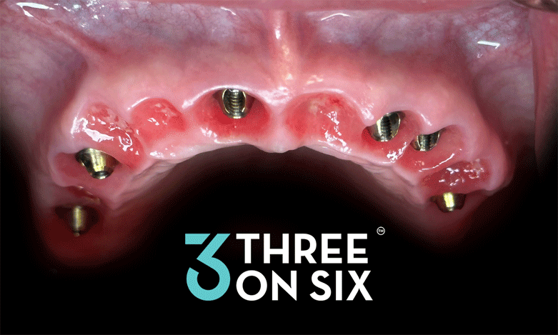 補(bǔ)牙流程3D光柵卡片